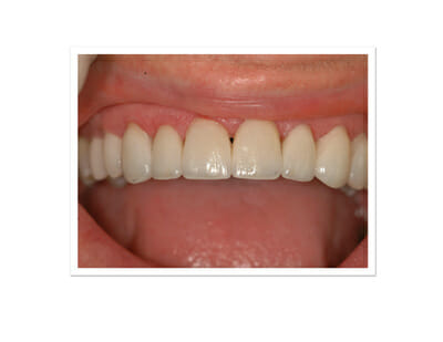 Before And After Teeth Veneers. Here are the permanent Veneers