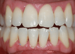 Invisalign Lite
