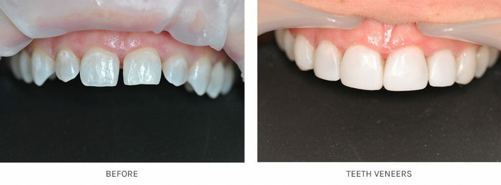 Teeth Veneers