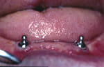 Implants for dentures