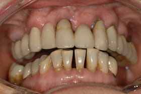 Cheap dental implants