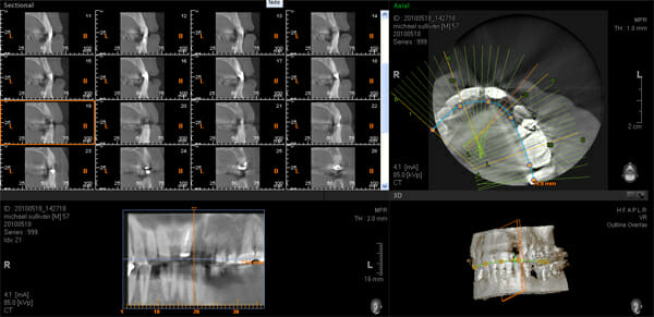 An example screen grab from our Specialist Dental CT Scanner