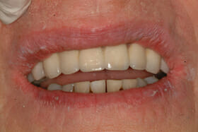 whole mouth full set dental implants