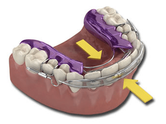 how the inman aligner works