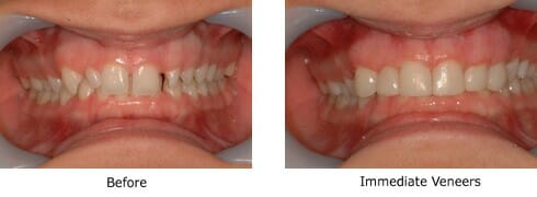 Immediate veneers before and after picture