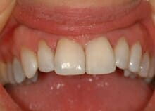 Immediate Veneers to Close Gap between upper front teeth