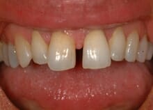Immediate Veneers to Close Gap between upper front teeth