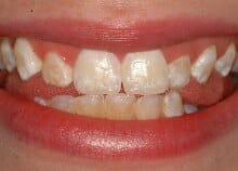 Immediate Veneers - Upper Front Teeth