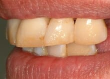 Upper and Lower Implant retained dentures