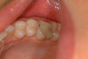 a n other dentist white filling