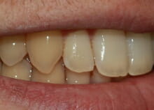 Straightening Teeth without Visible Braces after 2