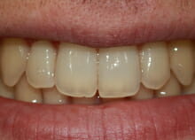 Straightening Teeth without Visible Braces after