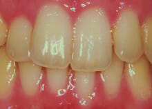 Straightening Teeth without Visible Braces