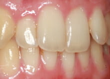 Straightening Teeth without Visible Braces before