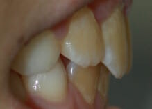 early orthodontics - teeth straightening for children in essex after