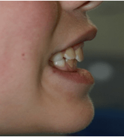 an overbite correction teeth fixed