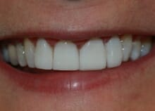 instant veneers before and after