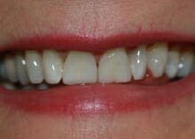 teeth whitening before and after photos