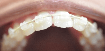 6 month smile brackets