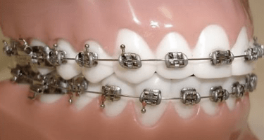 traditional braces