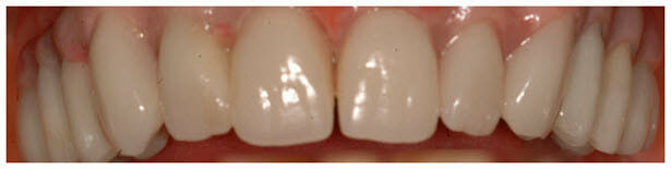 Acrylic Implant Dentures