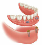 Implant dentures