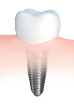 Single Dental Implant