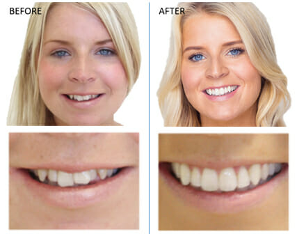 mikala-invisalign-before-and-after-reading