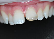 case-1-immediate-veneer-micro-invasive-before