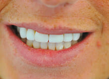 case-4-immediate-veneers-after-2