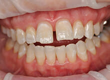 case-4-immediate-veneers-before