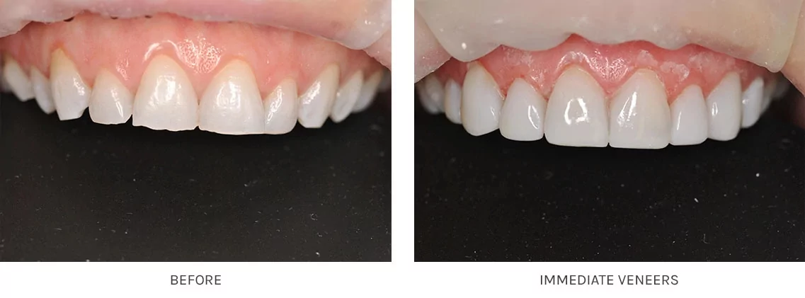 full set of veneers before and after photos