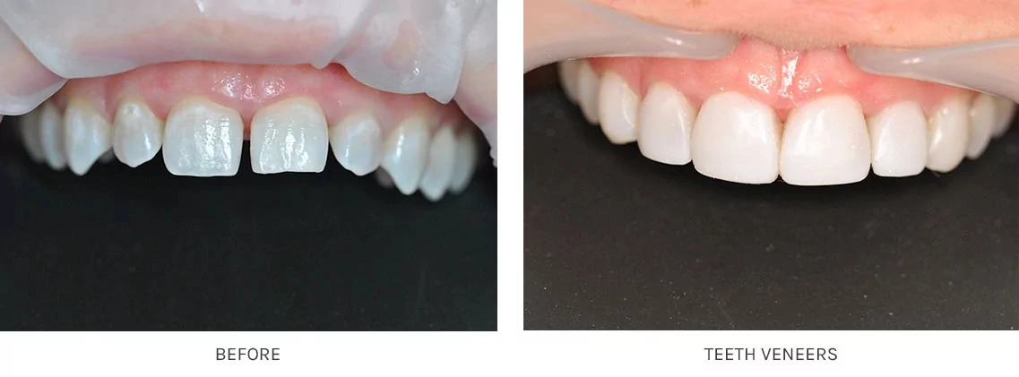 Full Set of Veneers before and after pictures