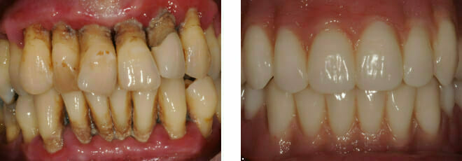 Failing Teeth from Periodontal Disease | Gum Disease Treatment in Romford, Essex | Winning Smiles Dental Clinic