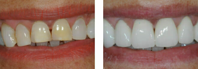 Porcelain Crowns and Ageing | Cosmetic Dentistry in Romford, Essex