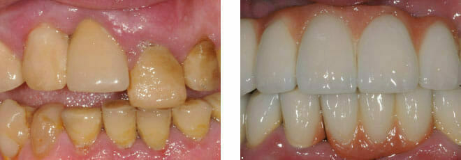 Dental Crowns and Implants in Romford, Essex | Upper and Lower Teeth | Winning Smiles