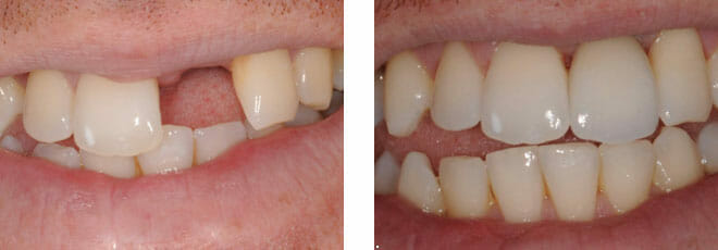 missing front tooth before and after