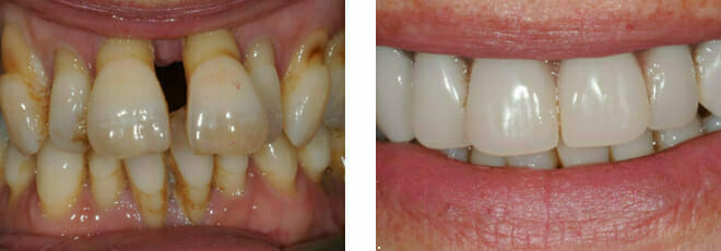 Teeth in a Day in Romford, Essex | Winning Smiles Dental Clinic