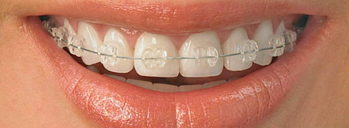 Ceramic Braces - Billericay Orthodontics