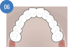 “Teeth in an hour” – immediate implant technique