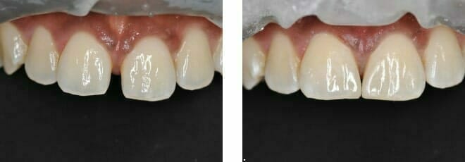 Immediate Veneers Before and After in Romford, Essex | Cosmetic Dentistry