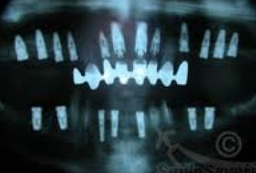 Dental Implant CT Scan