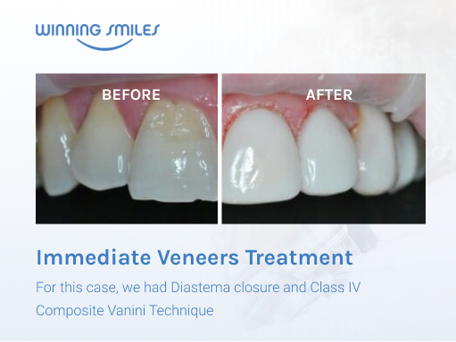 teeth veneers before and after