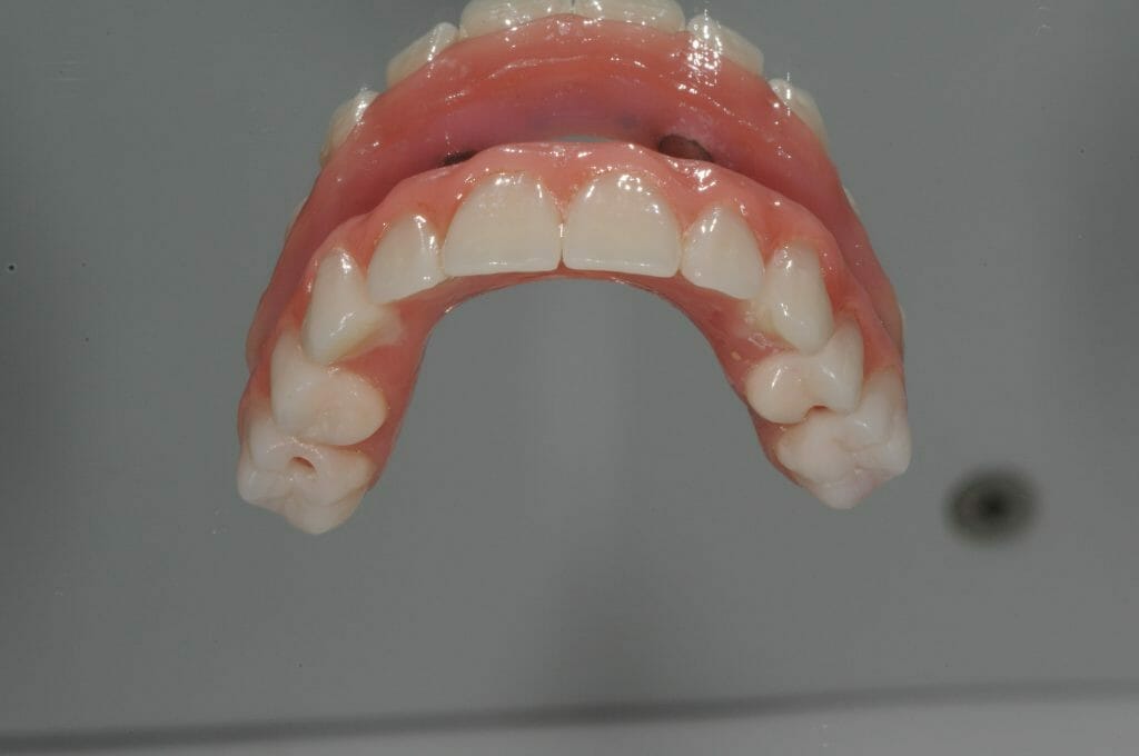 Option 2: Permanently fixed full mouth implant acrylic teeth
