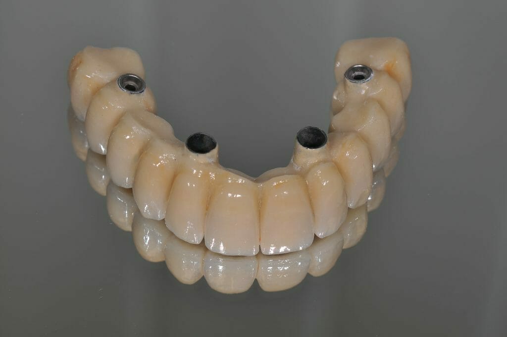 Option 3: Permanently fixed full mouth implant ceramic teeth