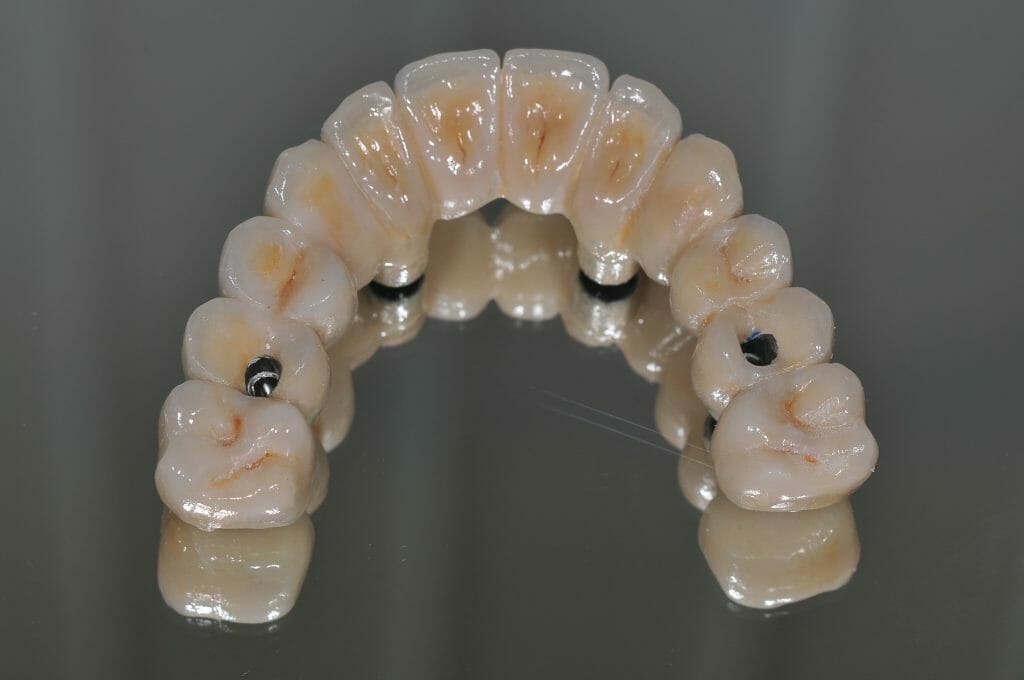 Option 3: Permanently fixed full mouth implant ceramic teeth