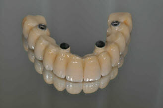 Permanently fixed full mouth implant ceramic teeth