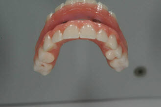 Acrylic Dental Implant Teeth